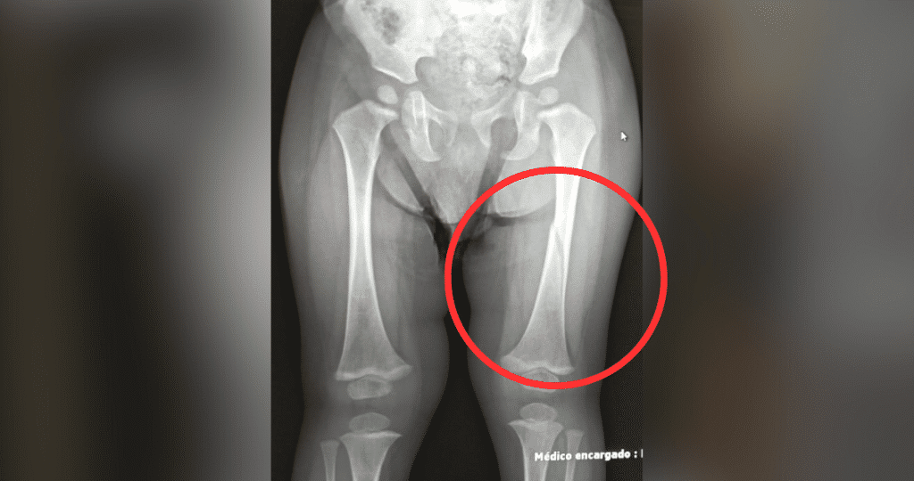 El pequeño Lucas, de un año y tres meses, con su pierna izquierda enyesada desde la cadera al pie tras sufrir una fractura de fémur.